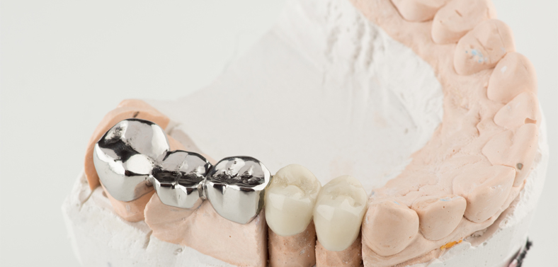 prosthodontics with bridges and crowns