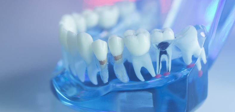 Root canal treatment