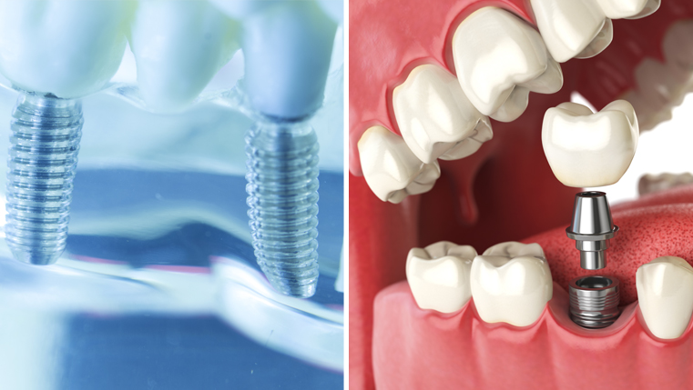 Zirconia dental implants vs titanium implants