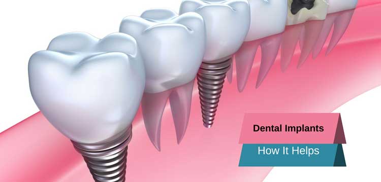 Dental implants and how it helps