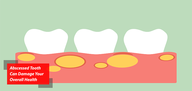An Abscessed Tooth Can Damage Your Overall Health Condition