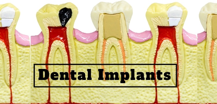 facts about dental implants for missing teeth