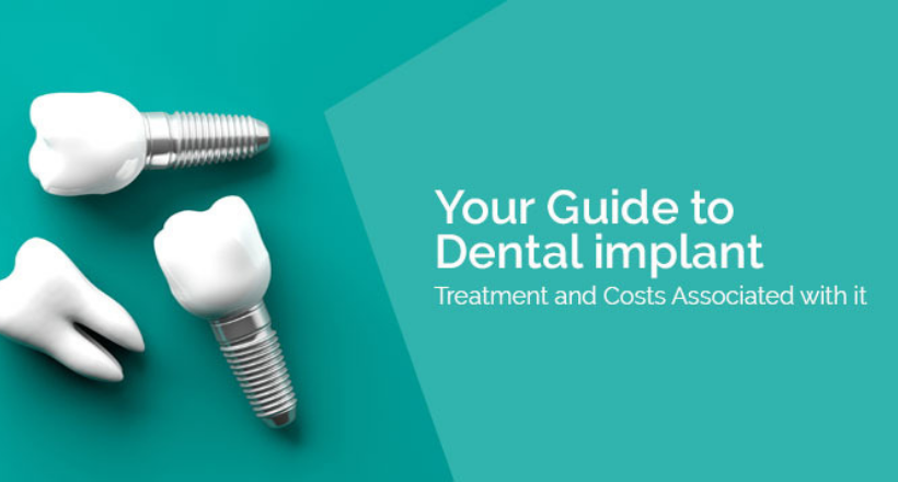 Dental Implant Guide
