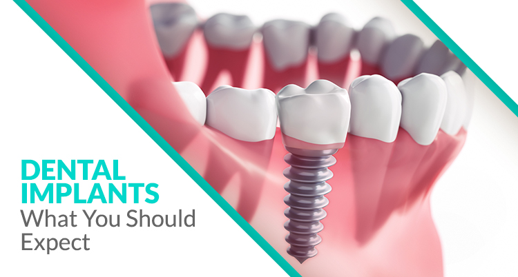 Dental Implants