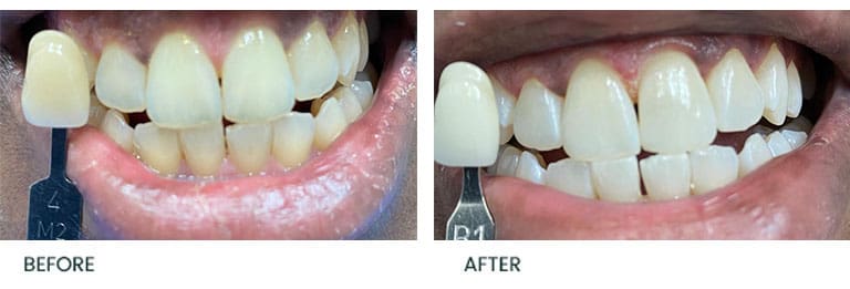 porcelain veneers before after2