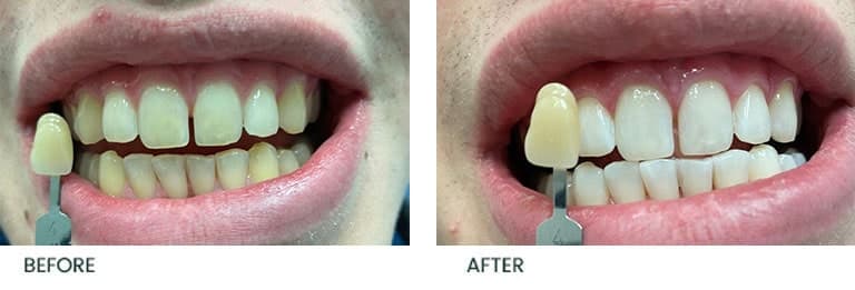 porcelain veneers before after3