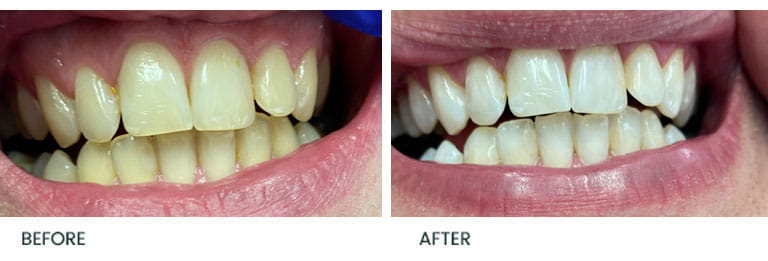 Teeth Whitening Before After 1 - Wimpole Dental Office