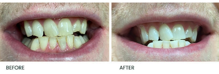 Teeth Whitening Before After 10 - Wimpole Dental Office