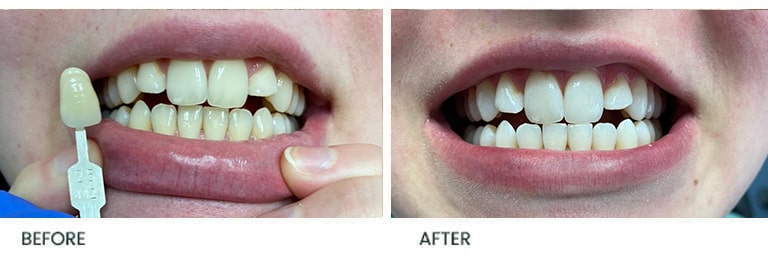 Teeth Whitening Before After 15 - Wimpole Dental Office