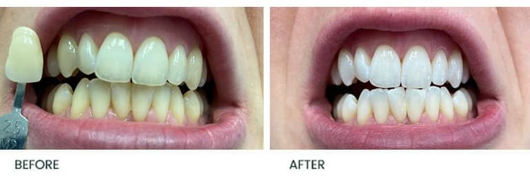 Teeth Whitening Before After 2 - Wimpole Dental Office