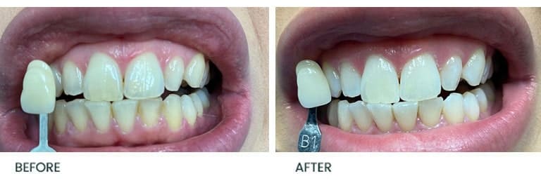 Teeth Whitening Before After 3 - Wimpole Dental Office