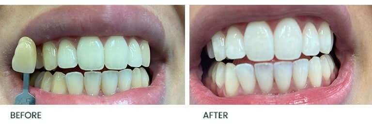Teeth Whitening Before After 4 - Wimpole Dental Office