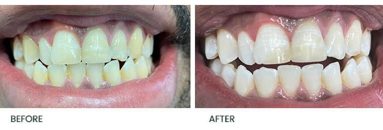 Teeth Whitening Before After 5 - Wimpole Dental Office