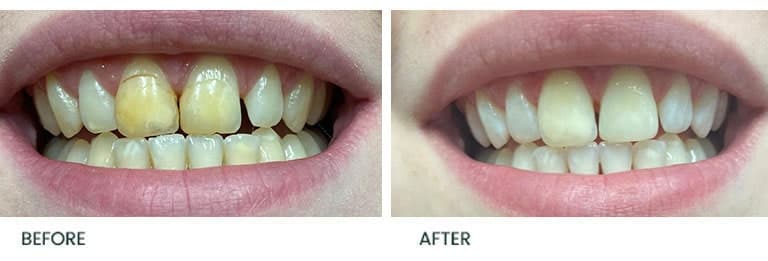 Teeth Whitening Before After 6 - Wimpole Dental Office