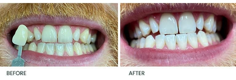Teeth Whitening Before After 8 - Wimpole Dental Office