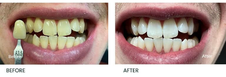 Teeth Whitening with Veneers Before After - Wimpole Dental Office