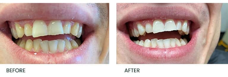 Teeth Whitening Treatment 2