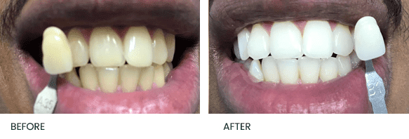 Teeth Whitening